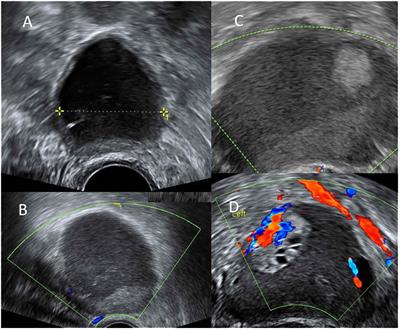 Case report: Malignant transformation of ovarian endometrioma during long term use of dienogest in a young lady